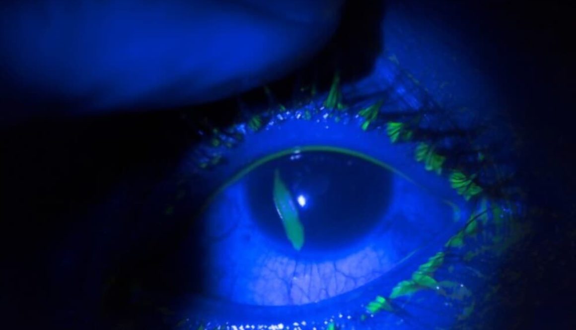 Corneal-Abrasion