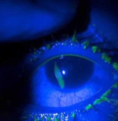 Corneal-Abrasion