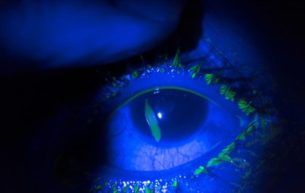 The Ultimate Guide To Corneal Abrasion