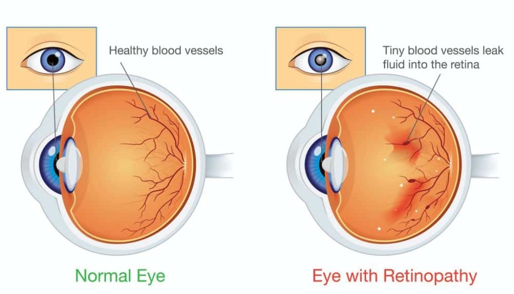 diabetic-retinopathy