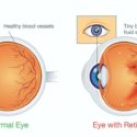 diabetic-retinopathy