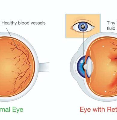 diabetic-retinopathy