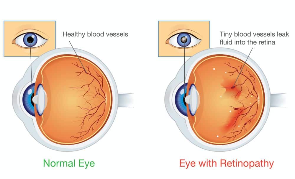 A Step-by-step Guide To Diabetic Retinopathy