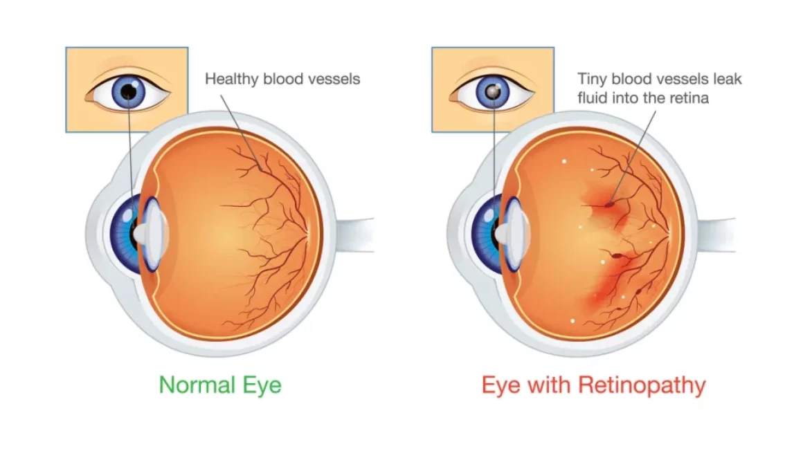 A medical illustration showing the progression of diabetic retinopathy in the eye.