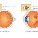 A medical illustration showing the progression of diabetic retinopathy in the eye.