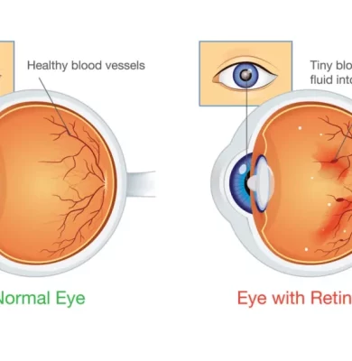 A medical illustration showing the progression of diabetic retinopathy in the eye.