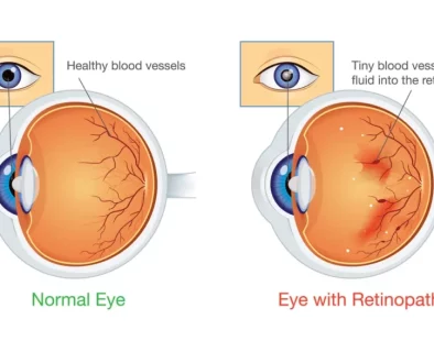 A medical illustration showing the progression of diabetic retinopathy in the eye.