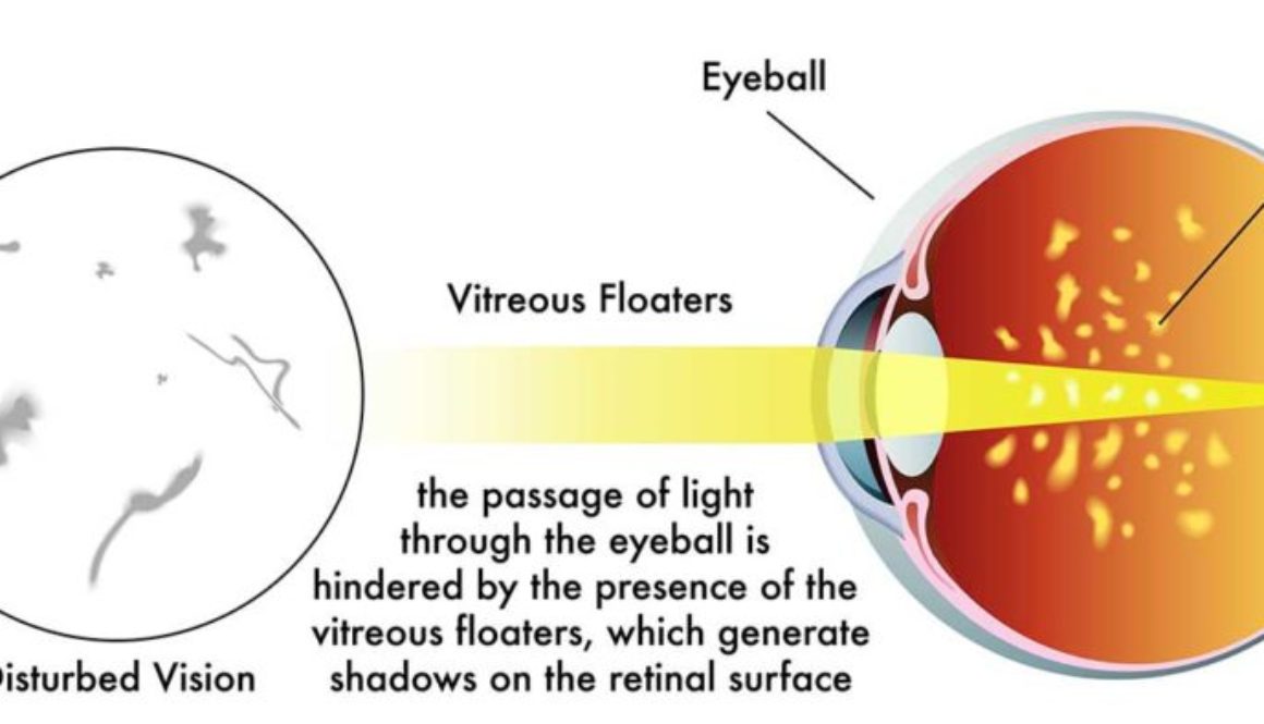 A close-up image of eye floaters, small specks and strands floating in a clear field of vision.