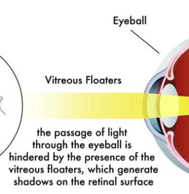 A close-up image of eye floaters, small specks and strands floating in a clear field of vision.
