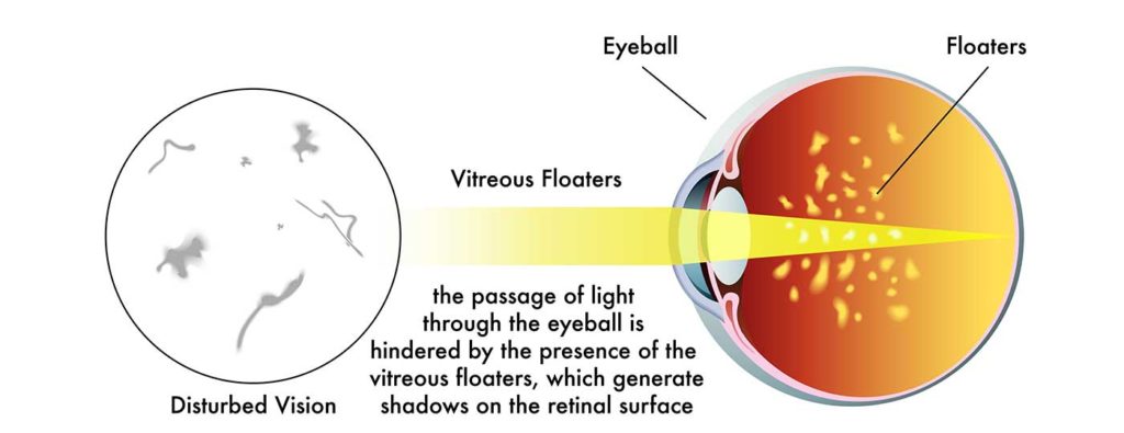 Eye Floaters – Symptoms and Causes